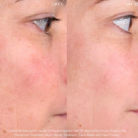 Advance Treatment Set